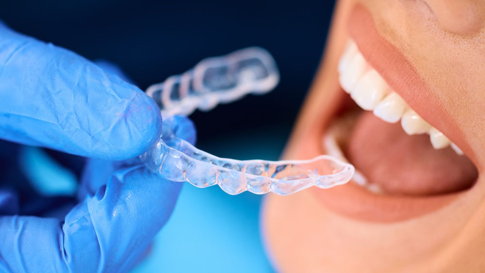 The Revolution of Clear Aligners: Transformin